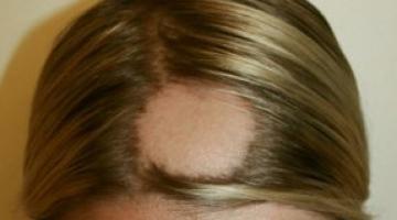 Alopecia Areata